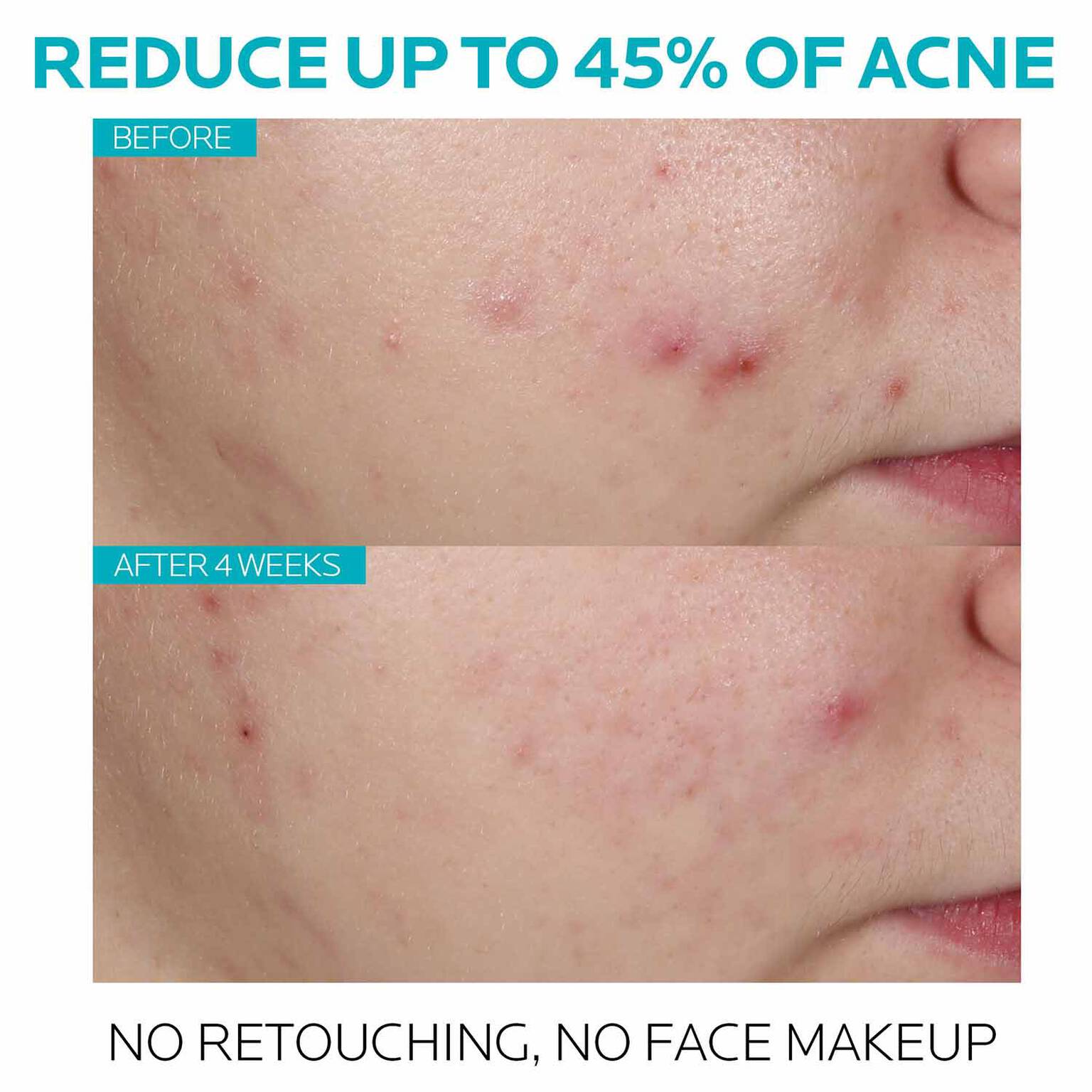 effaclar-salicylic-acid-acne-treatment-serum-v8 7_EffaclarSerum_After-45-days.jpg