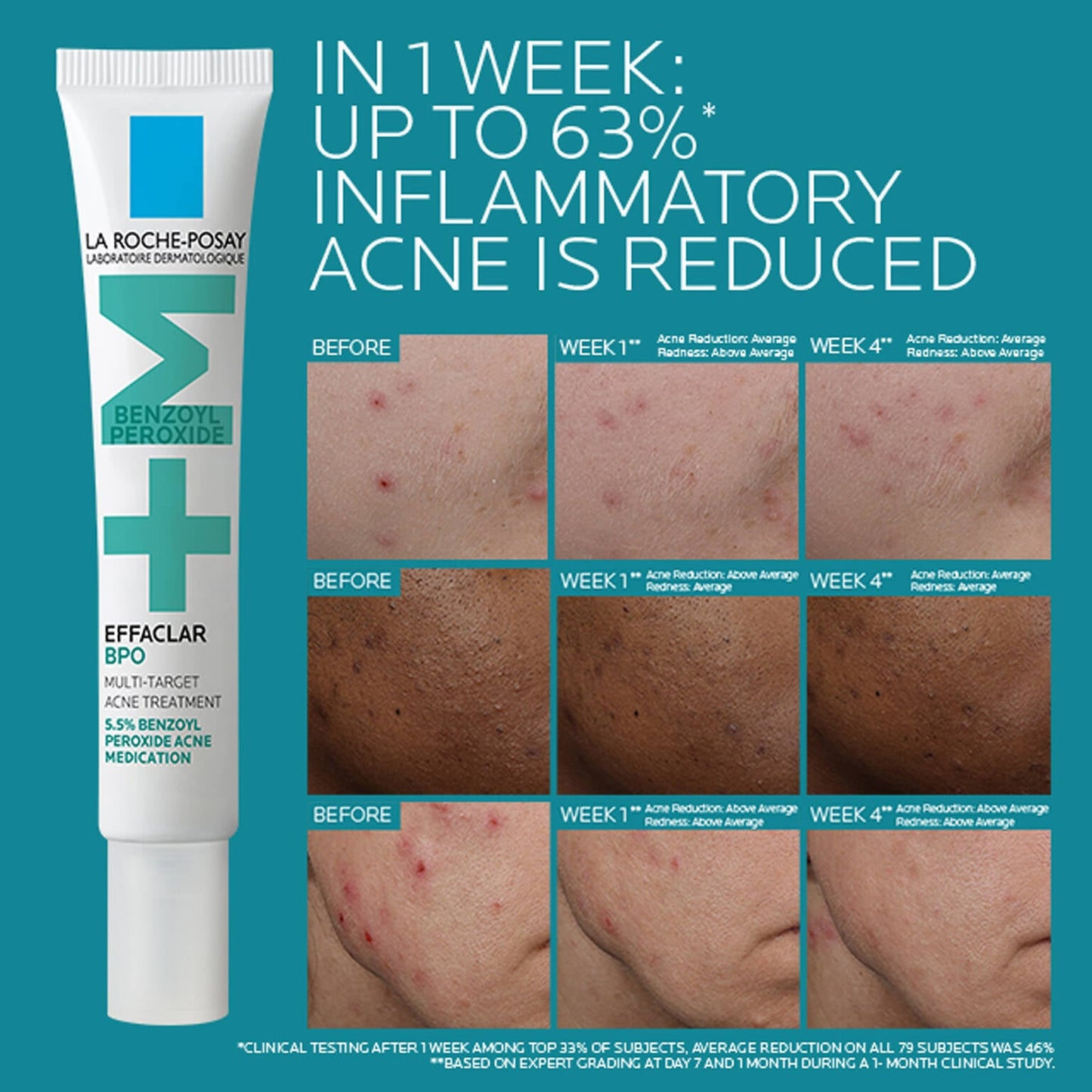 effaclar-bpo-multi-target-acne-treatment-with-5-5-benzoyl-peroxide-h4 EffaclarBPO-ClinicalBA-ATF-1500x1500-2.jpg