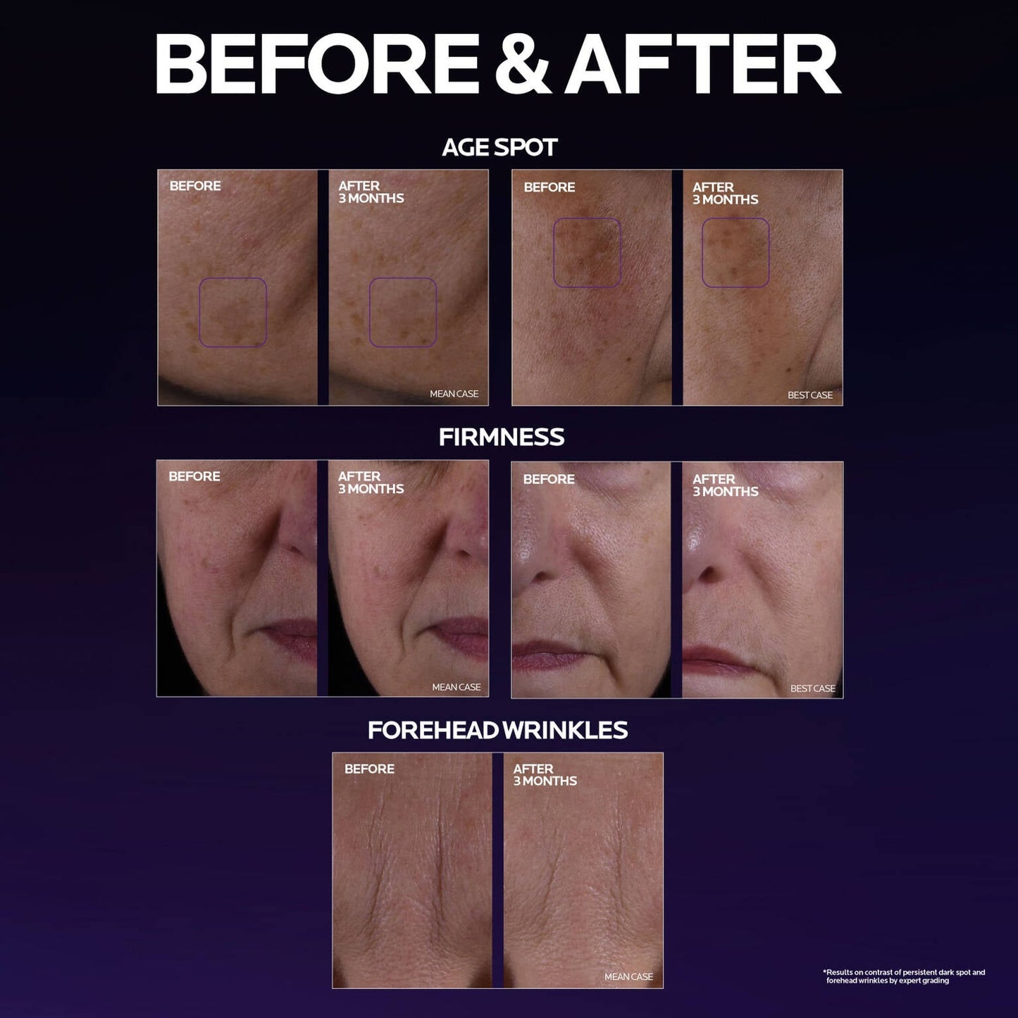 mela-b3-double-dose-discoloration-treatment-with-melasyltm-k5 MelaB3_DD_BTF_BeforeAfter_1500x1500_5.jpg