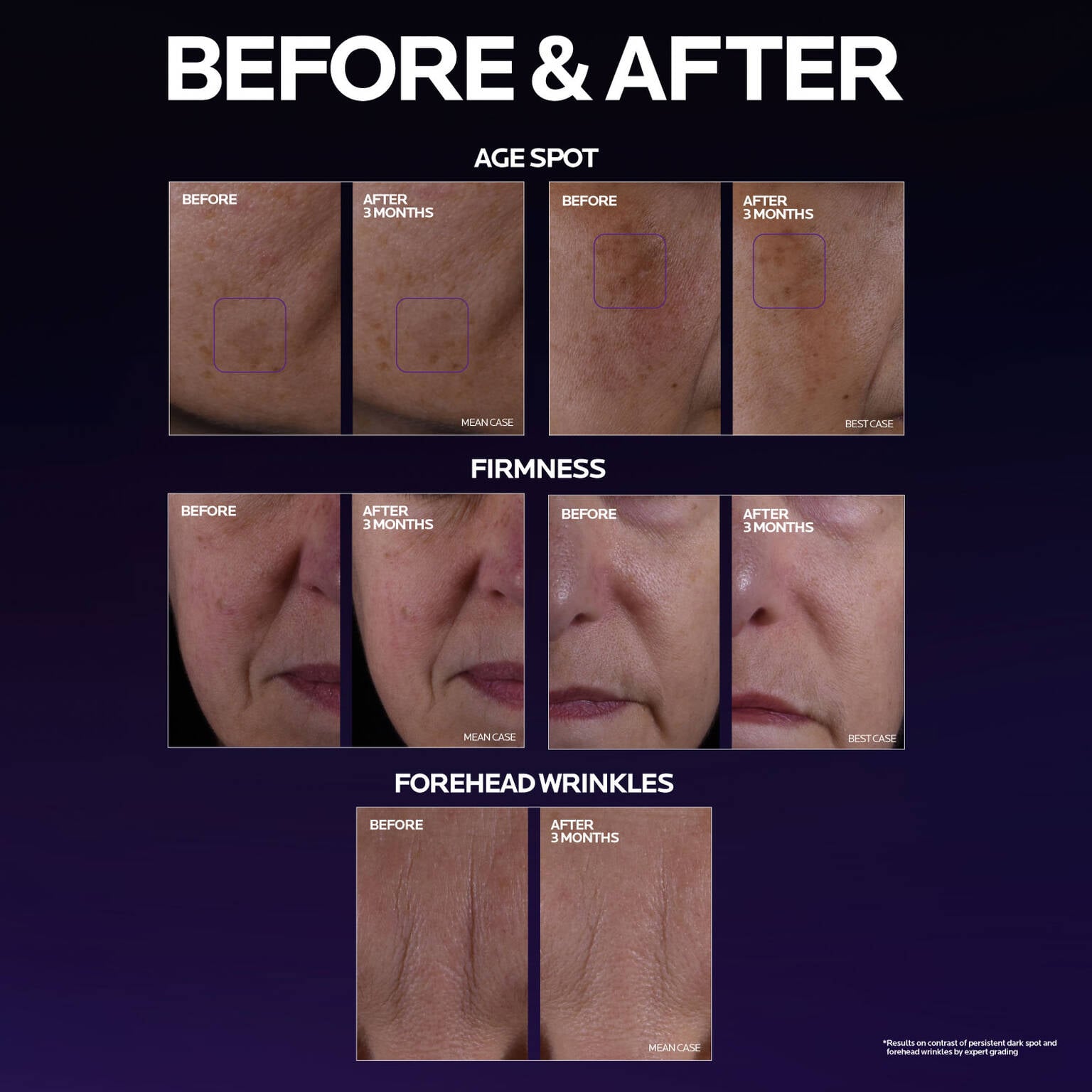 mela-b3-double-dose-discoloration-treatment-with-melasyltm-k5 MelaB3_DD_BTF_BeforeAfter_1500x1500_5.jpg